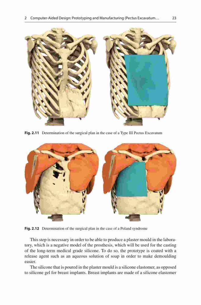 Pectus Custom Pectus Excavatum and Poland Syndrome Surgery: Custom-Made Silicone ...
