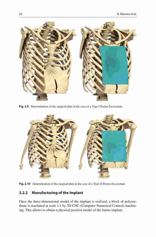 Pectus Custom Pectus Excavatum and Poland Syndrome Surgery: Custom-Made Silicone ...