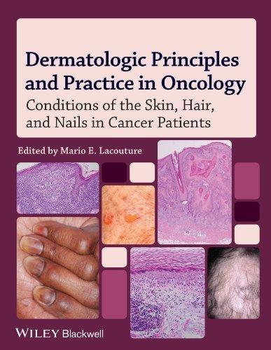 Dermatologic Principles and Practice in Oncology: Conditions of the Skin, Hair, and Nails in Cancer Patients, 1st Edition - FULL INSTANT DOWNLOAD | PDF DOCX EPUB